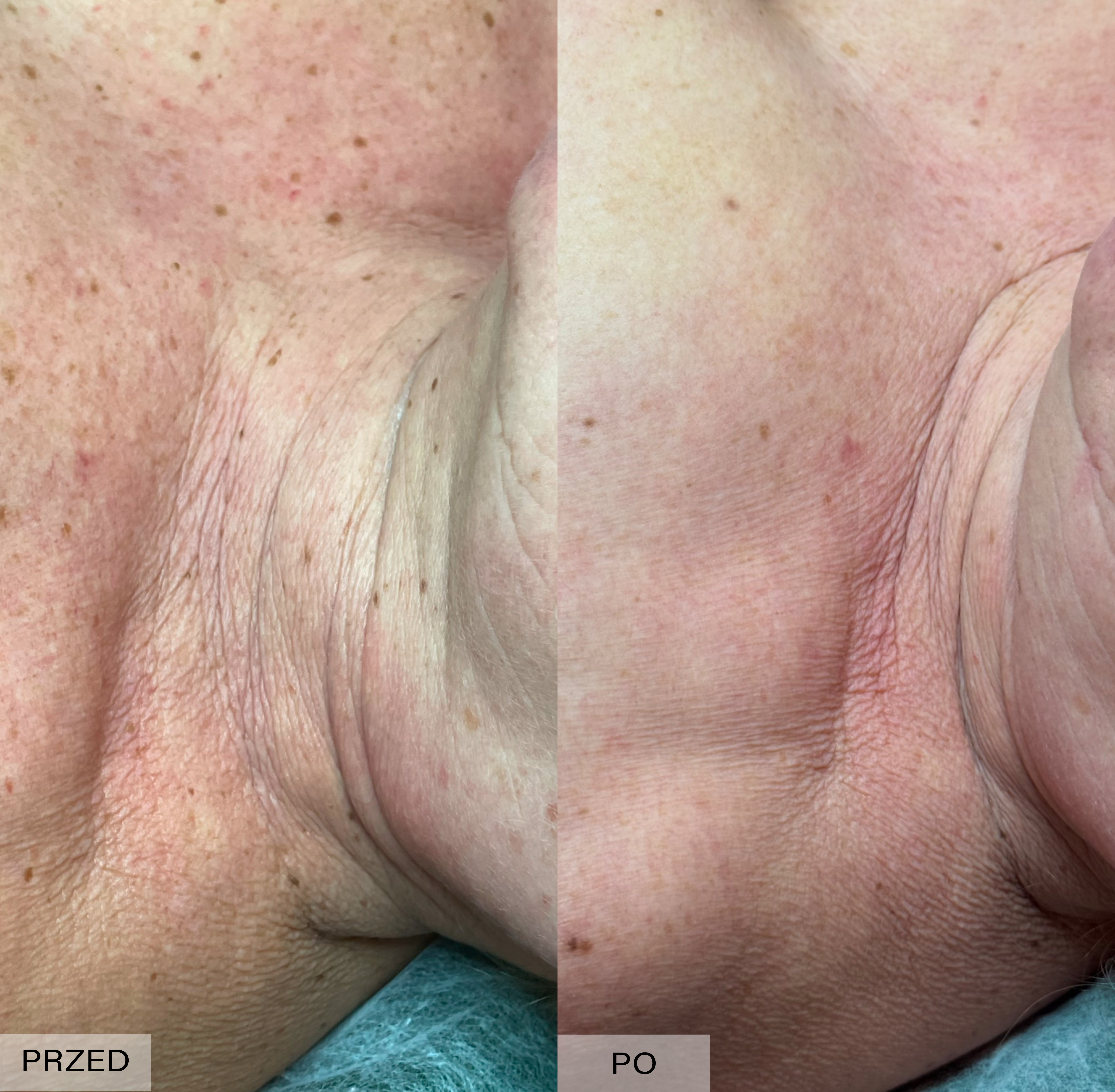 fototerapia ipl efekty